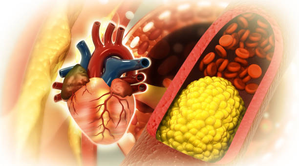 cholesterol blocked artery with human heart. 3d illustration